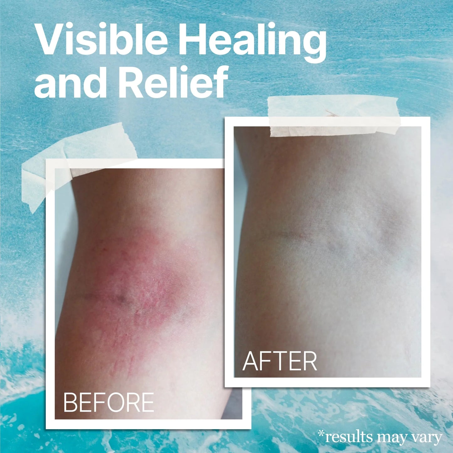 The Ocean Healed My Eczema Natural & Soothing Eczema Cream